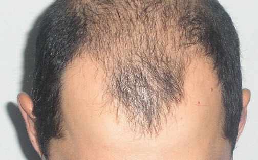 Андрогенное выпадение волос