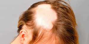 Неожиданное выпадение волос - алопеция у женщин (очаговая)
